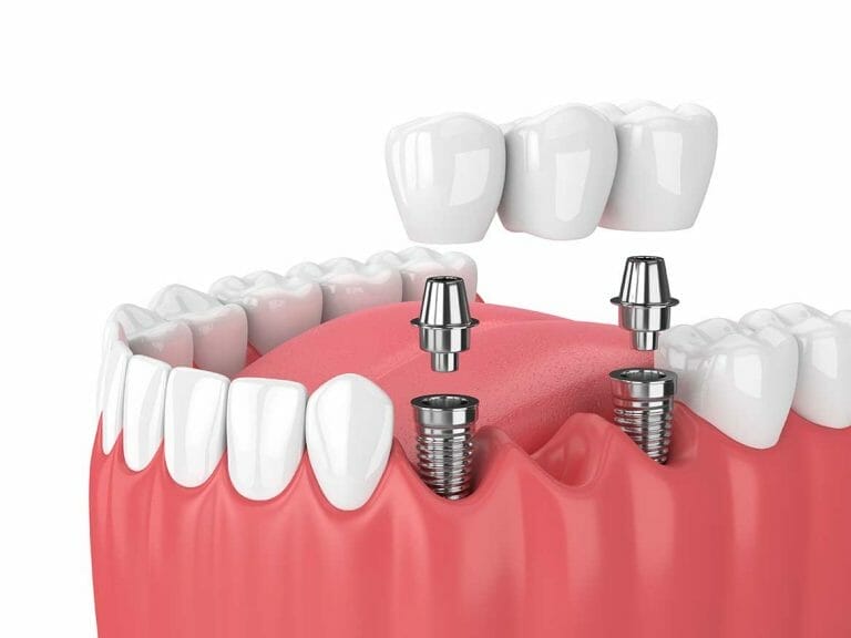 Implant dentaire : Pourquoi effectuer l’implant ?