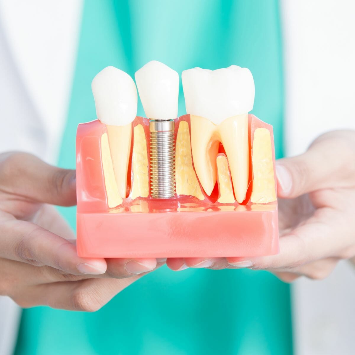 Implant dentaire : comment l’installer dans la bouche ?